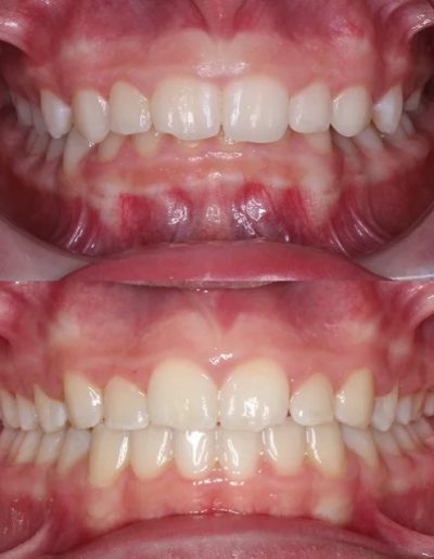 smile design orthodontics houston tx smile gallery deep bite