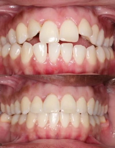 smile design orthodontics houston tx smile gallery open bite 2